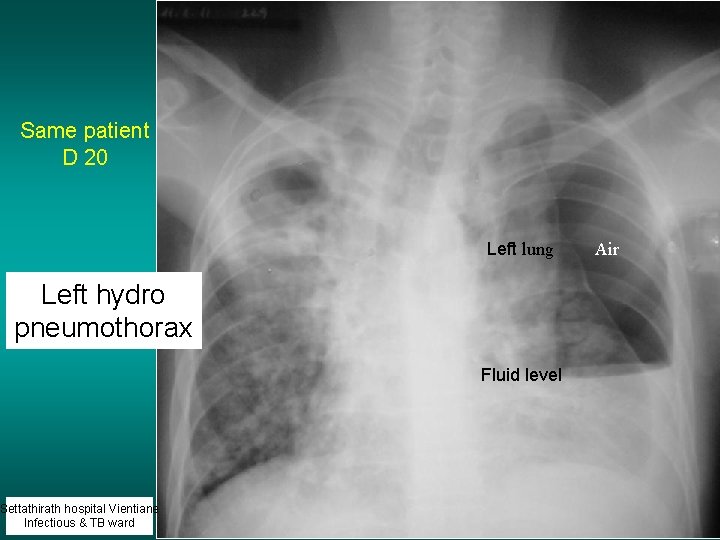 Same patient D 20 Left lung Left hydro pneumothorax Settathirath hospital Vientiane Infectious &