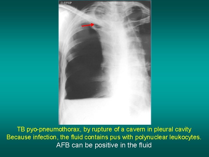 TB pyo-pneumothorax, by rupture of a cavern in pleural cavity Because infection, the fluid