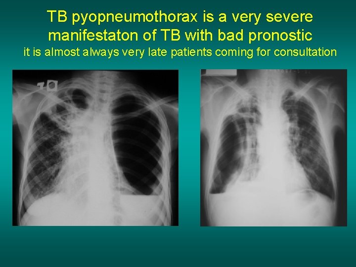 TB pyopneumothorax is a very severe manifestaton of TB with bad pronostic it is