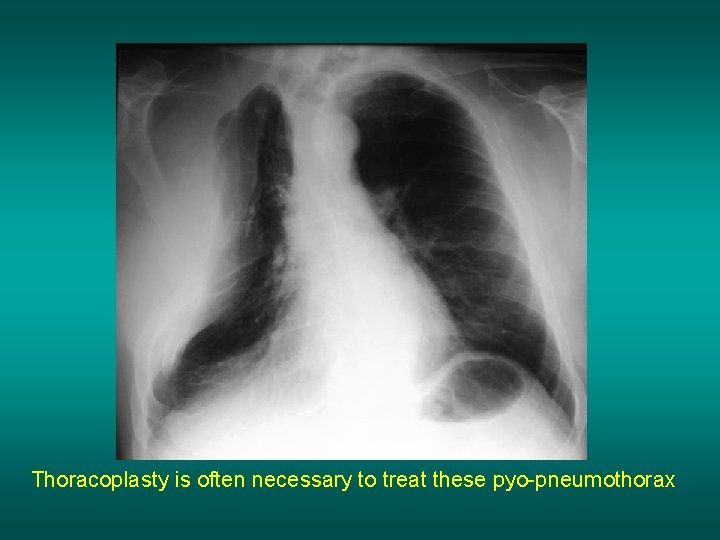 Thoracoplasty is often necessary to treat these pyo-pneumothorax 