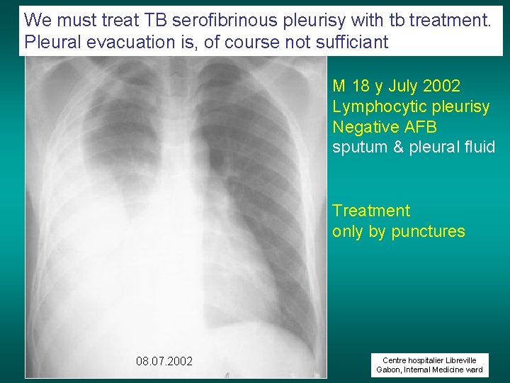 We must treat TB serofibrinous pleurisy with tb treatment. Pleural evacuation is, of course