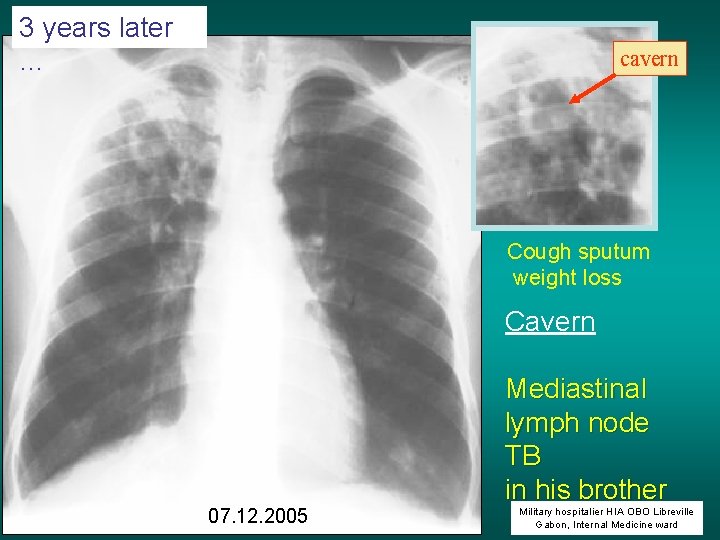 3 years later … cavern Cough sputum weight loss Cavern 07. 12. 2005 Mediastinal
