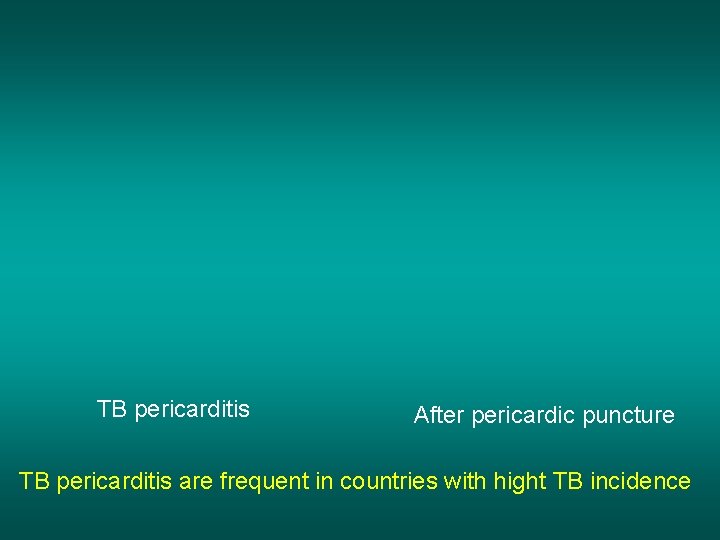 TB pericarditis After pericardic puncture TB pericarditis are frequent in countries with hight TB