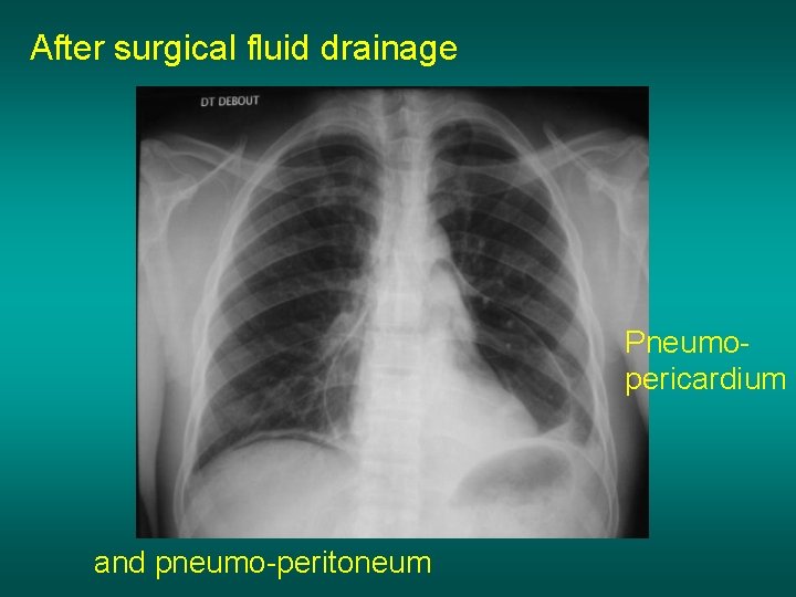 After surgical fluid drainage Pneumopericardium and pneumo-peritoneum 
