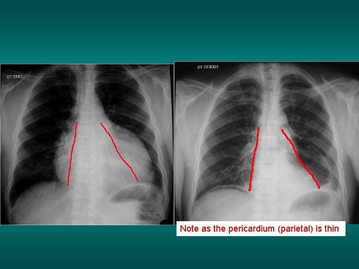 Note as the pericardium (parietal) is thin 