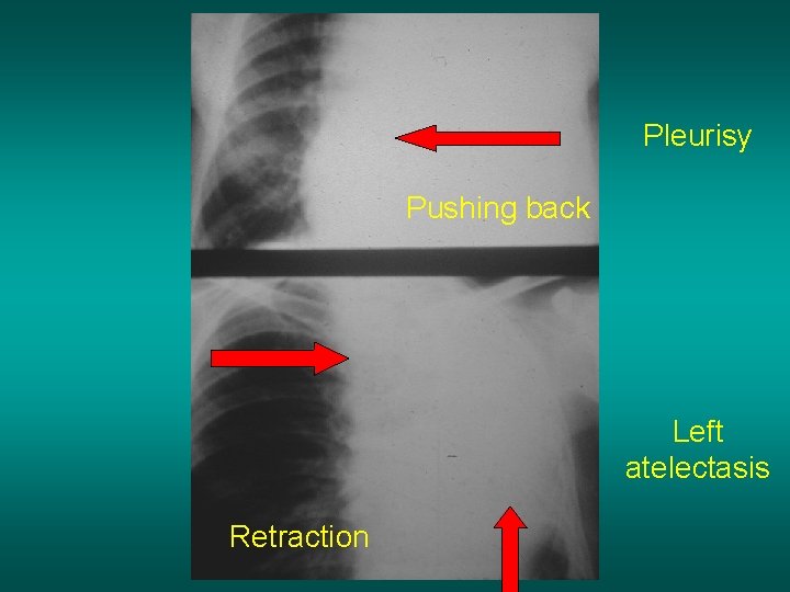 Pleurisy Pushing back Left atelectasis Retraction 