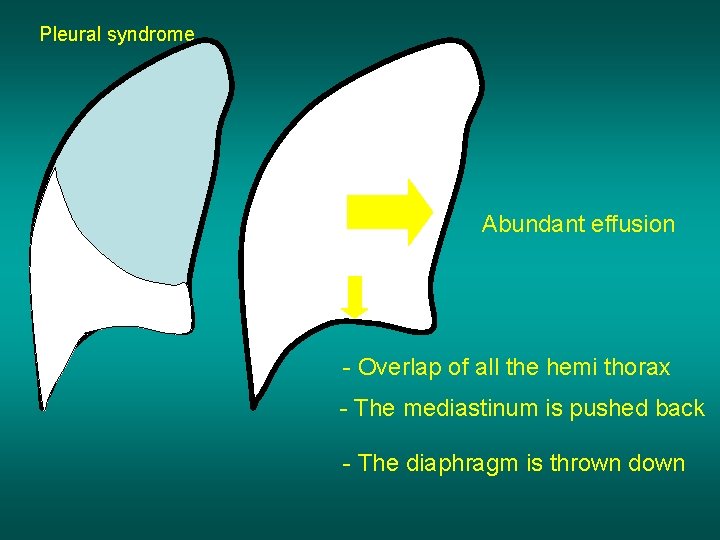 Pleural syndrome Abundant effusion - Overlap of all the hemi thorax - The mediastinum