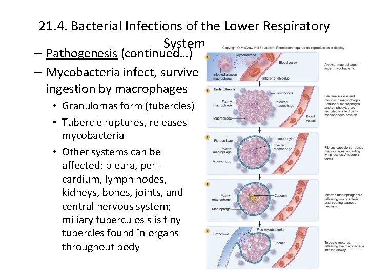 21. 4. Bacterial Infections of the Lower Respiratory System – Pathogenesis (continued…) – Mycobacteria