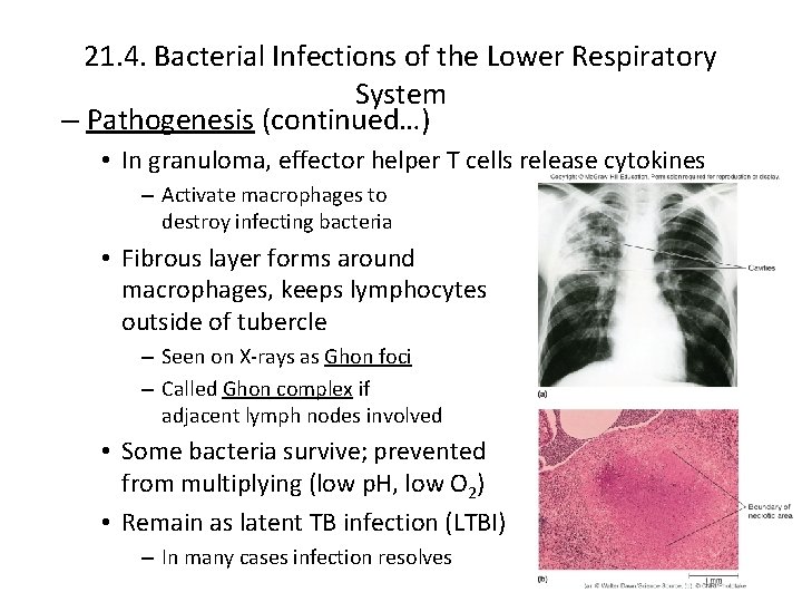 21. 4. Bacterial Infections of the Lower Respiratory System – Pathogenesis (continued…) • In