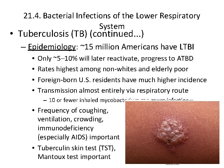 21. 4. Bacterial Infections of the Lower Respiratory System • Tuberculosis (TB) (continued. .