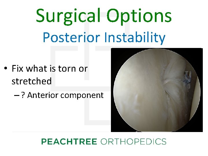 Surgical Options Posterior Instability • Fix what is torn or stretched – ? Anterior