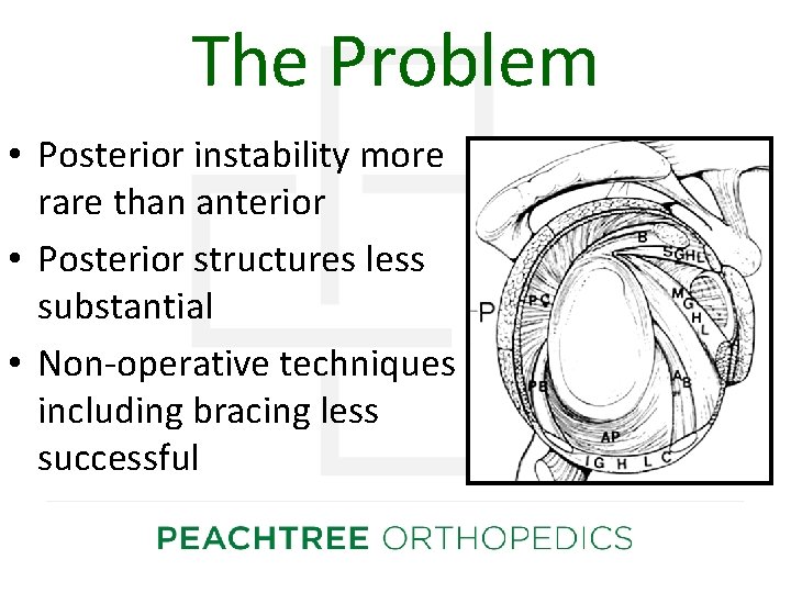 The Problem • Posterior instability more rare than anterior • Posterior structures less substantial