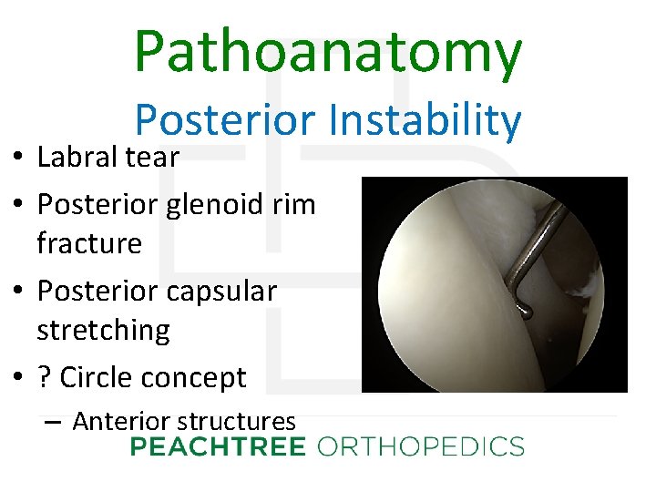 Pathoanatomy Posterior Instability • Labral tear • Posterior glenoid rim fracture • Posterior capsular