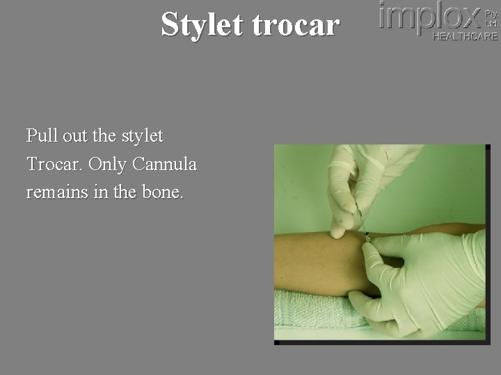 Stylet trocar Pull out the stylet Trocar. Only Cannula remains in the bone. 