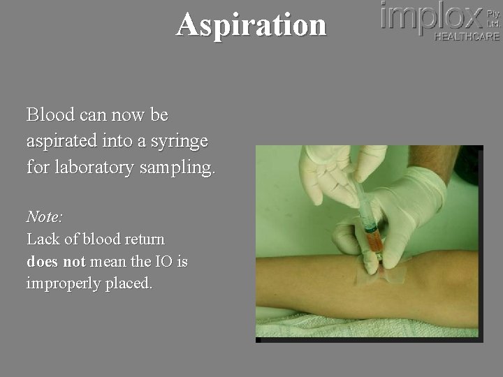 Aspiration Blood can now be aspirated into a syringe for laboratory sampling. Note: Lack