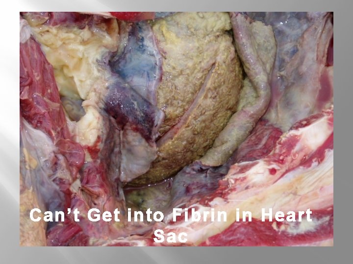 Can’t Get into Fibrin in Heart Sac 