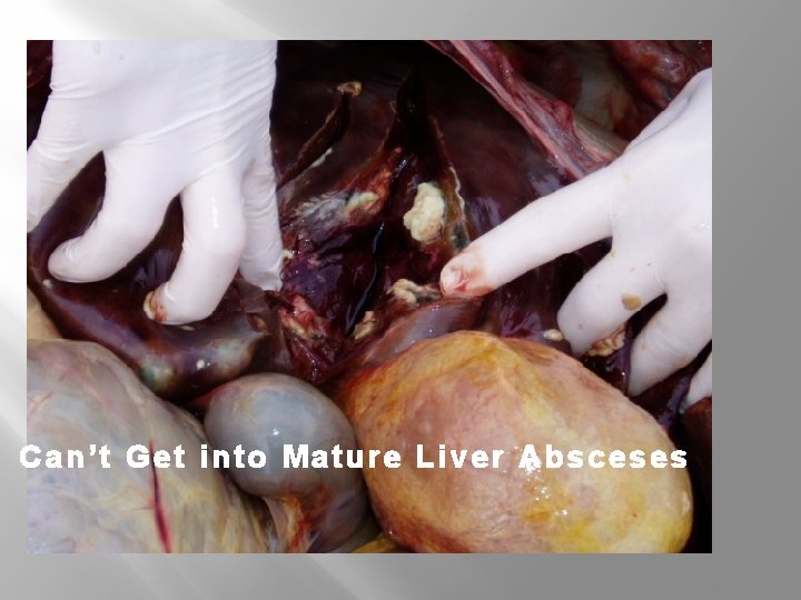 Can’t Get into Mature Liver Absceses 