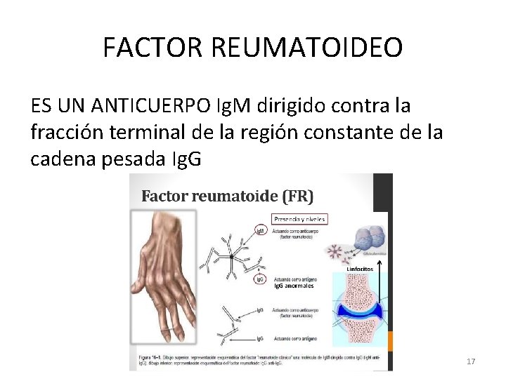 FACTOR REUMATOIDEO ES UN ANTICUERPO Ig. M dirigido contra la fracción terminal de la