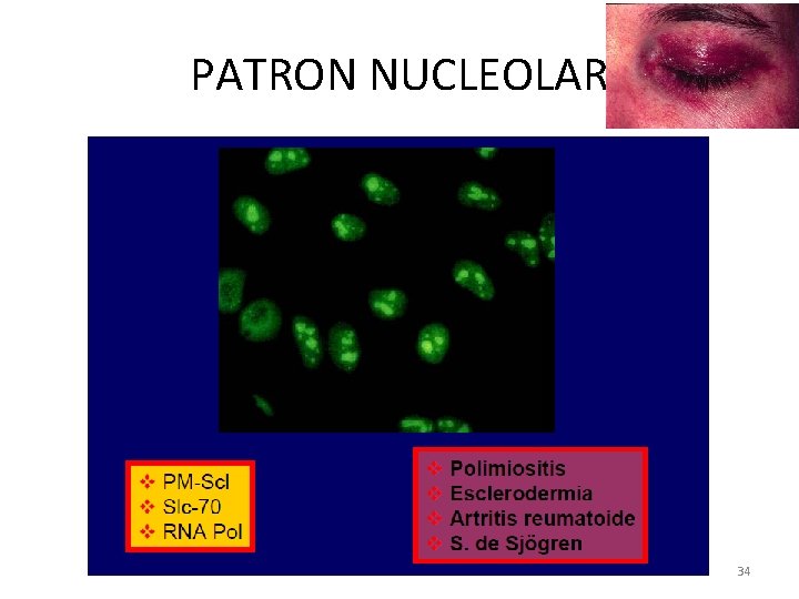 PATRON NUCLEOLAR Dra Roxana Blanco Villarte 34 
