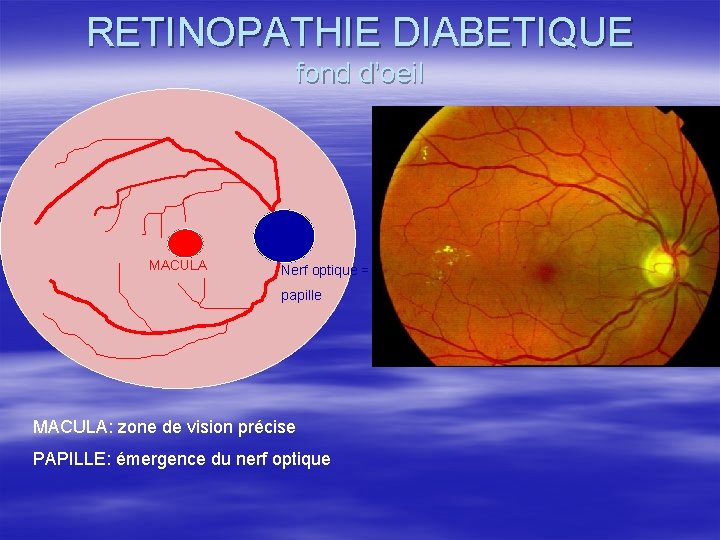 RETINOPATHIE DIABETIQUE fond d’oeil MACULA Nerf optique = papille MACULA: zone de vision précise