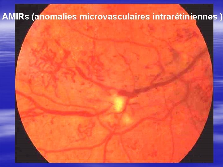 AMIRs (anomalies microvasculaires intrarétiniennes ) 