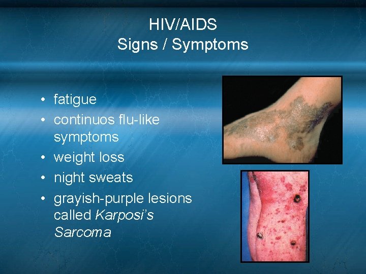 HIV/AIDS Signs / Symptoms • fatigue • continuos flu-like symptoms • weight loss • HIV/AIDS Signs / Symptoms • fatigue • continuos flu-like symptoms • weight loss •