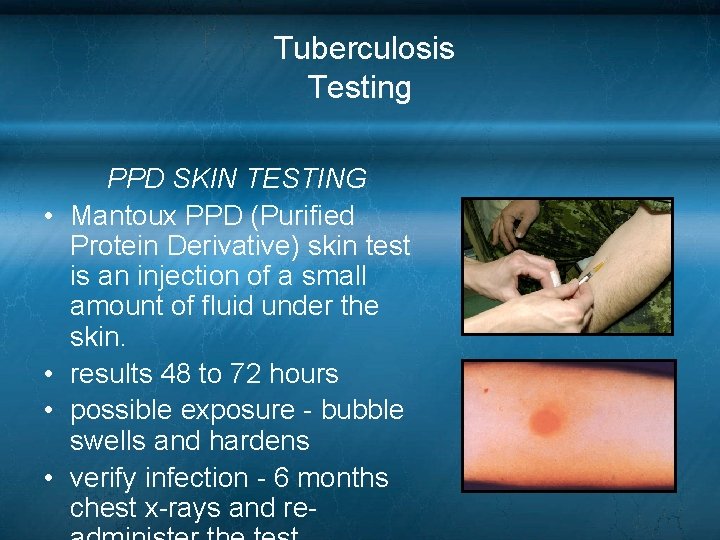 Tuberculosis Testing • • PPD SKIN TESTING Mantoux PPD (Purified Protein Derivative) skin test Tuberculosis Testing • • PPD SKIN TESTING Mantoux PPD (Purified Protein Derivative) skin test