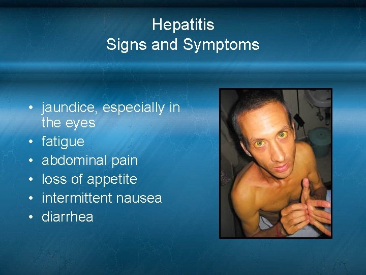 Hepatitis Signs and Symptoms • jaundice, especially in the eyes • fatigue • abdominal Hepatitis Signs and Symptoms • jaundice, especially in the eyes • fatigue • abdominal