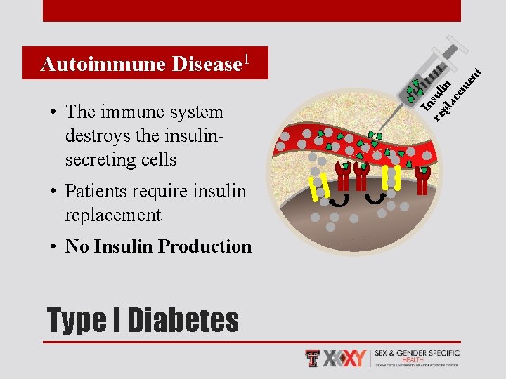  • The immune system destroys the insulinsecreting cells • Patients require insulin replacement