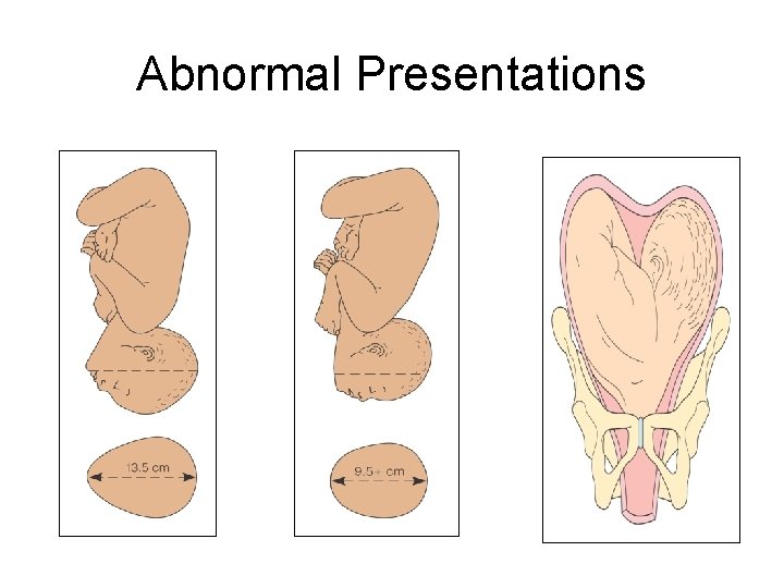 Abnormal Presentations 