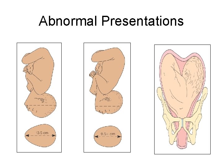 Abnormal Presentations 