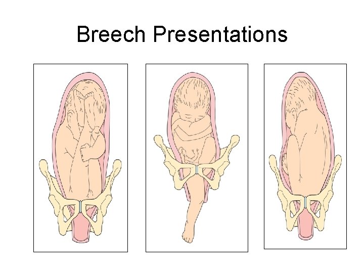 Breech Presentations 