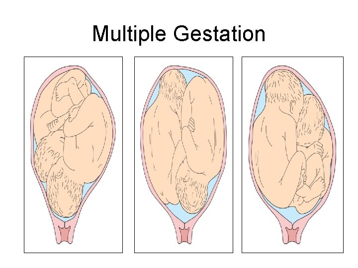 Multiple Gestation 