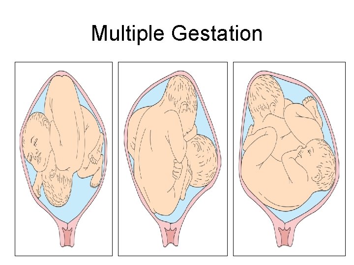 Multiple Gestation 