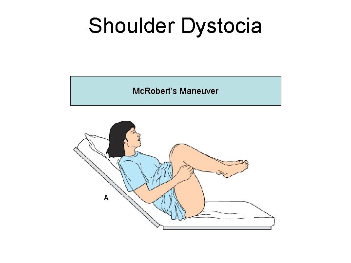 Shoulder Dystocia Mc. Robert’s Maneuver 