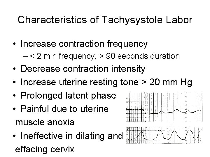 Characteristics of Tachysystole Labor • Increase contraction frequency – < 2 min frequency, >