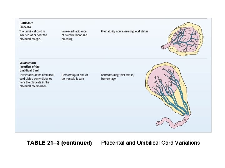TABLE 21– 3 (continued) Placental and Umbilical Cord Variations 