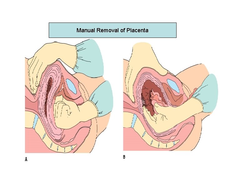 Manual Removal of Placenta 