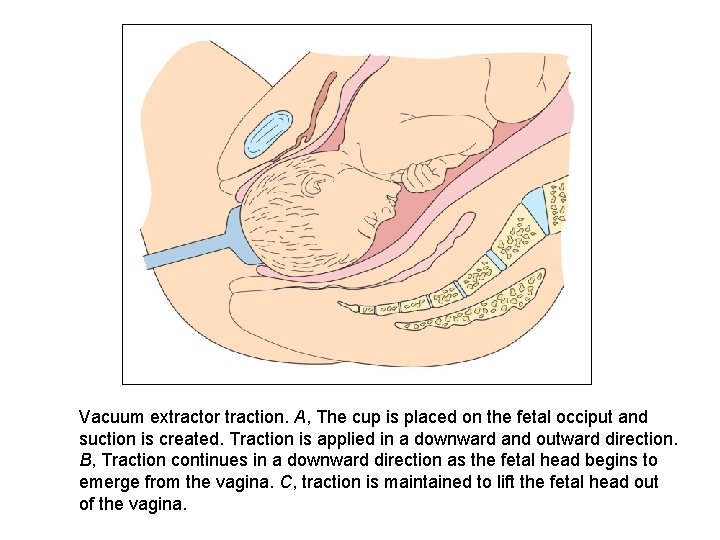 Vacuum extractor traction. A, The cup is placed on the fetal occiput and suction