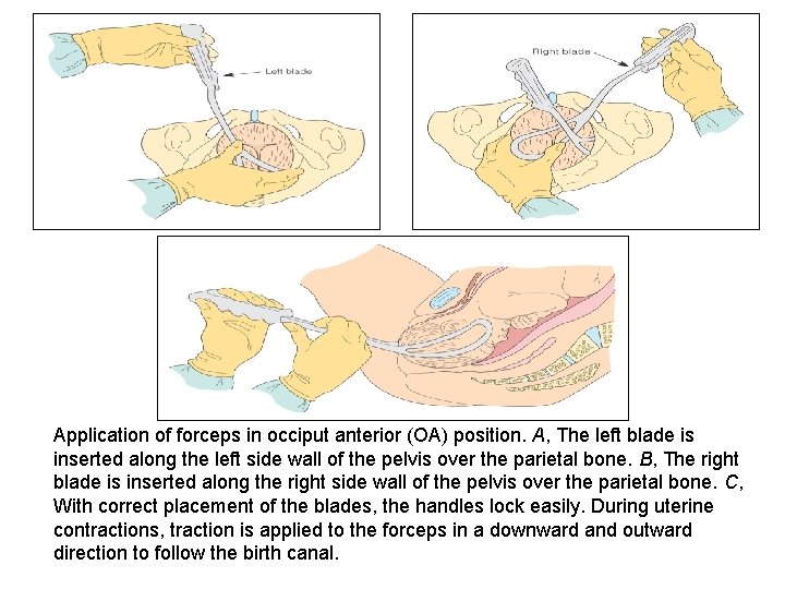 Application of forceps in occiput anterior (OA) position. A, The left blade is inserted