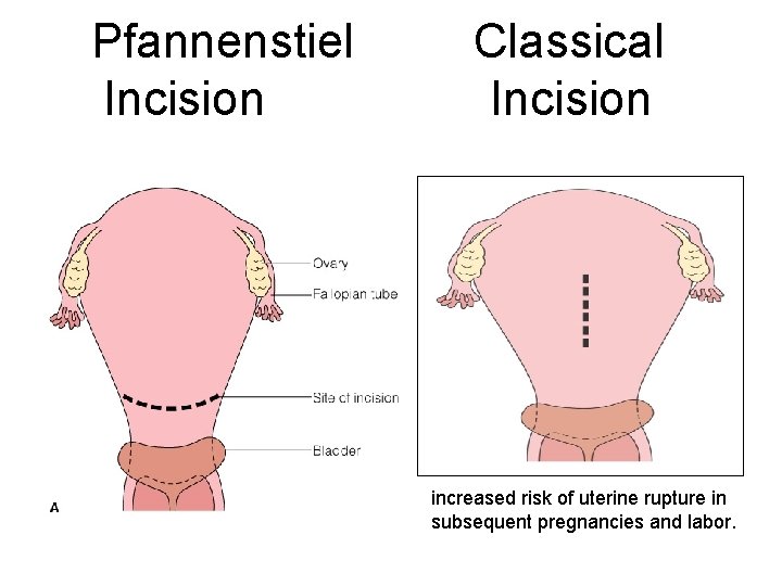 Pfannenstiel Incision Classical Incision increased risk of uterine rupture in subsequent pregnancies and labor.