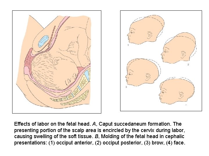 Effects of labor on the fetal head. A, Caput succedaneum formation. The presenting portion