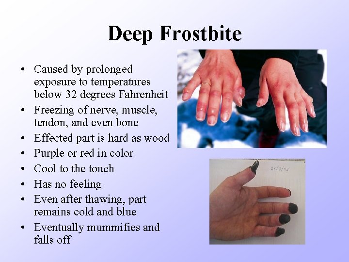 Deep Frostbite • Caused by prolonged exposure to temperatures below 32 degrees Fahrenheit •