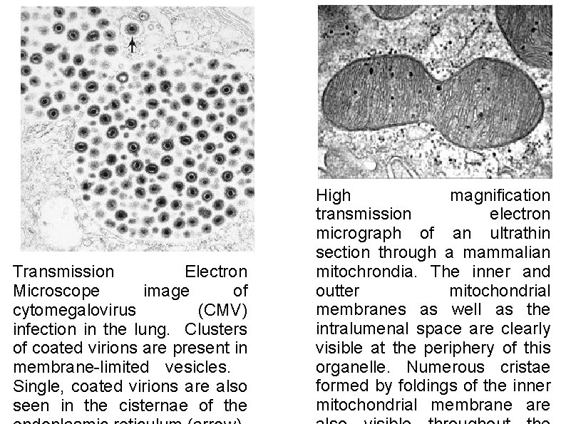 Transmission Electron Microscope image of cytomegalovirus (CMV) infection in the lung. Clusters of coated