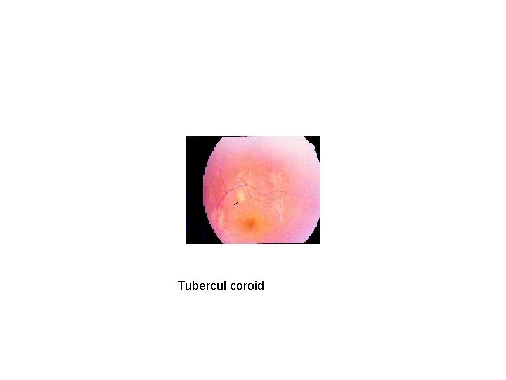 Tubercul coroid 