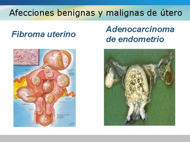 Afecciones benignas y malignas de útero Fibroma uterino Adenocarcinoma de endometrio 
