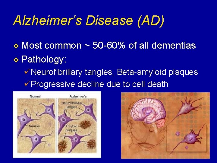 Alzheimer’s Disease (AD) v Most common ~ 50 -60% of all dementias v Pathology: