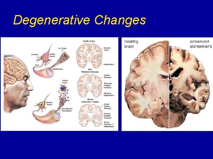 Degenerative Changes 