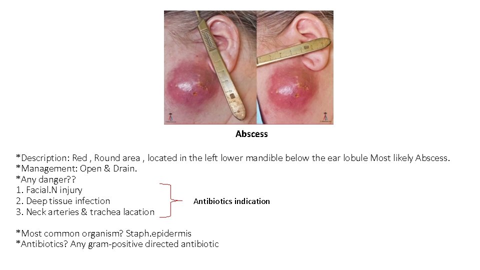 Abscess *Description: Red , Round area , located in the left lower mandible below