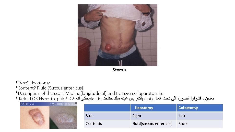 Stoma *Type? Ileostomy *Content? Fluid (Succus entericus) *Description of the scar? Midline[longitudinal] and transverse